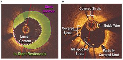 Coronary Stent Healing in Cancer Patients—An Optical Coherence Tomography Perspective